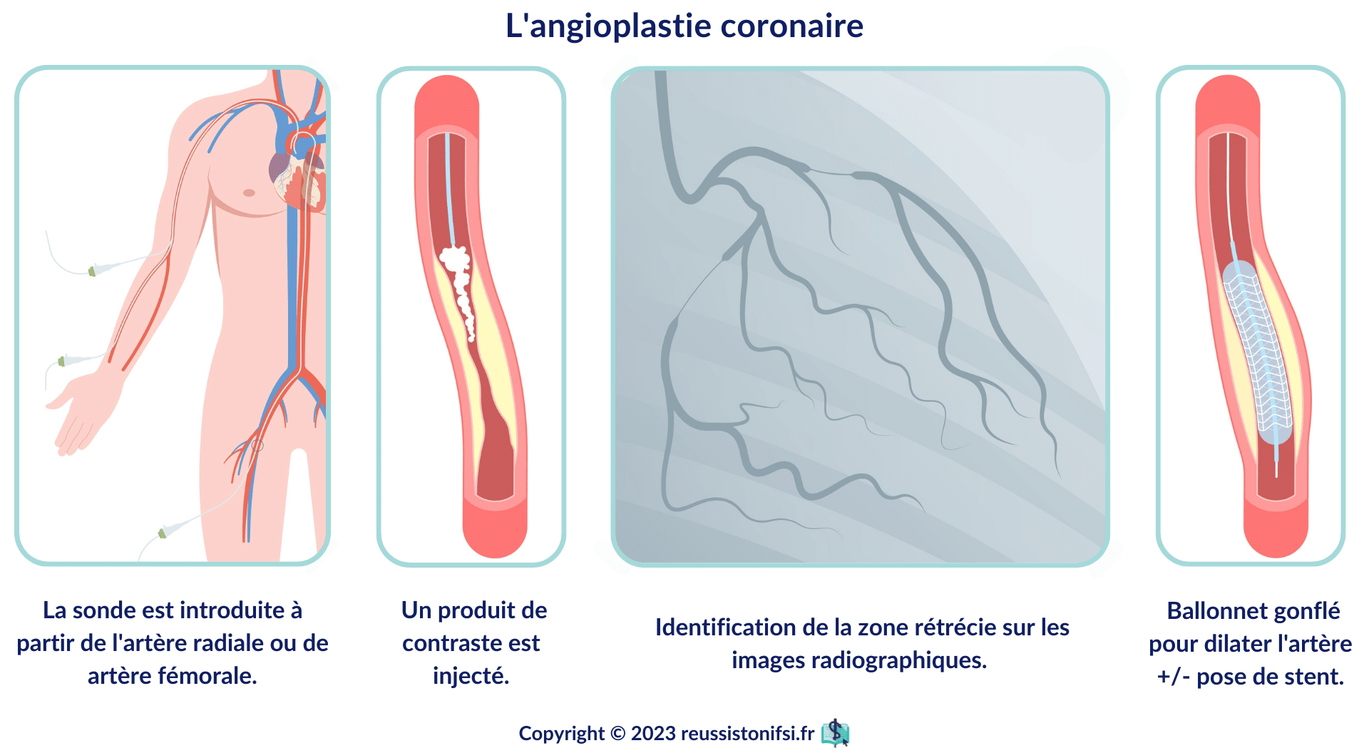 https://reussistonifsi.fr/tout-comprendre-sur-linfarctus-du-myocarde/